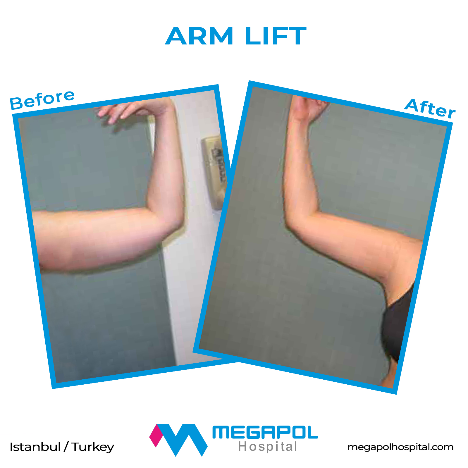 arm-lift-1