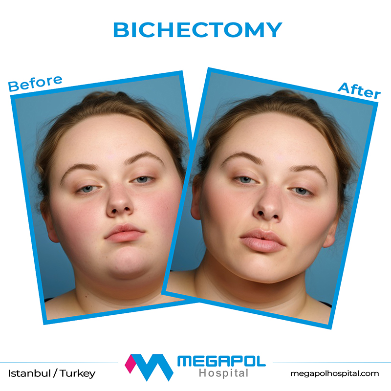 bichectomy-1