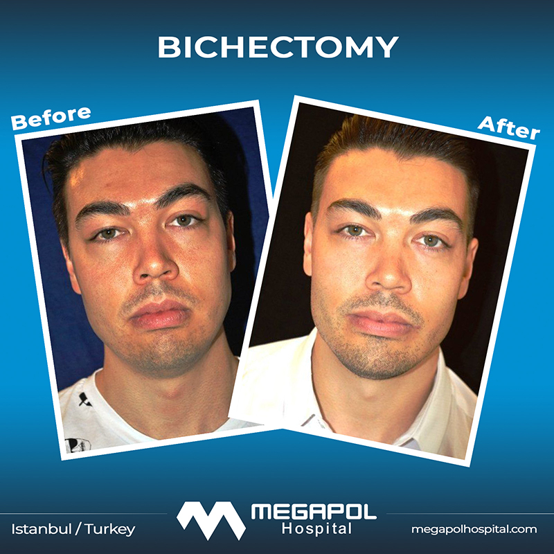 bichectomy-2