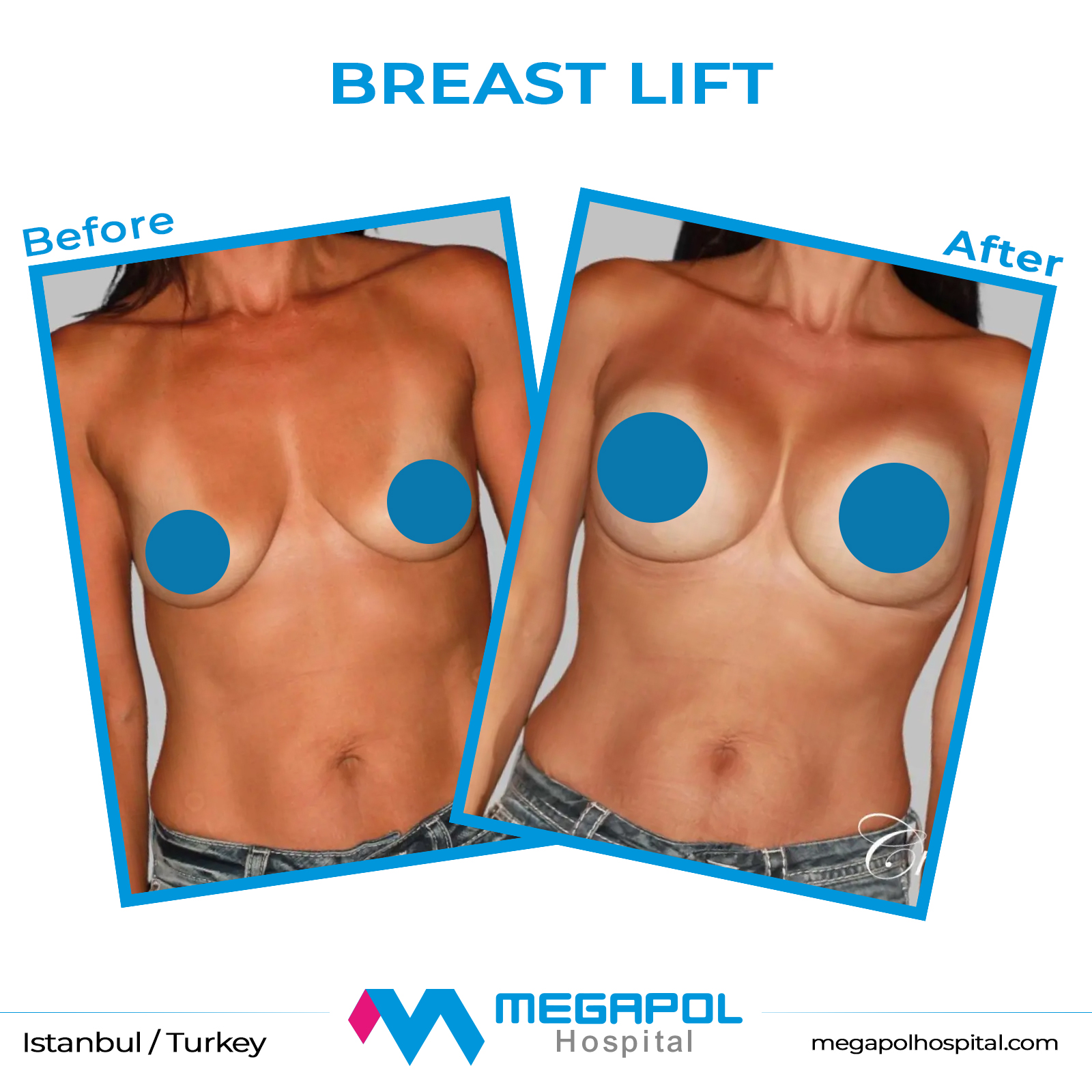 breast-lift-1