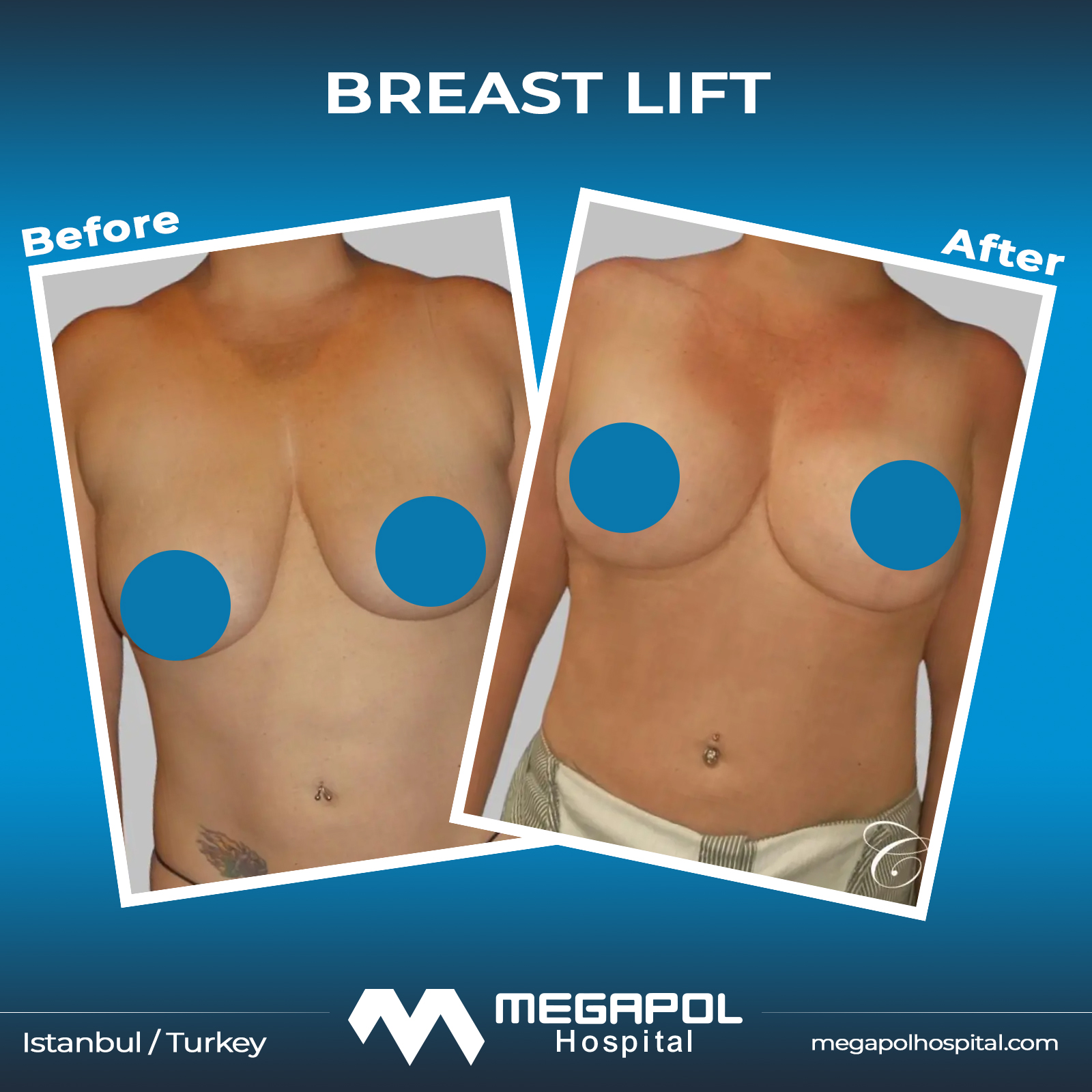 breast-lift-2