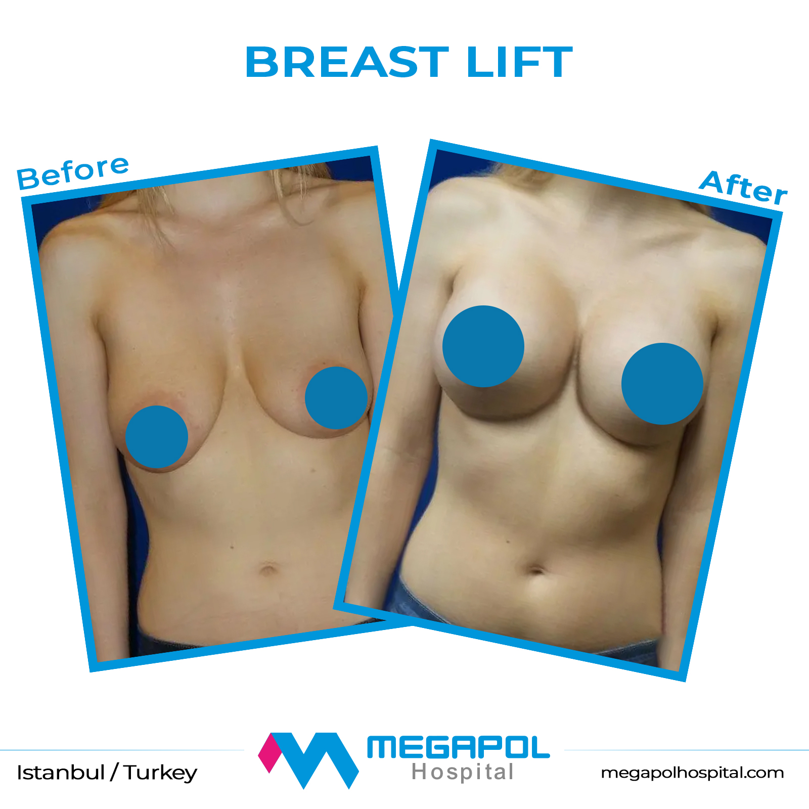 breast-lift-3