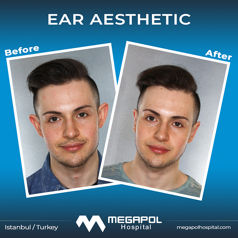 ear-1