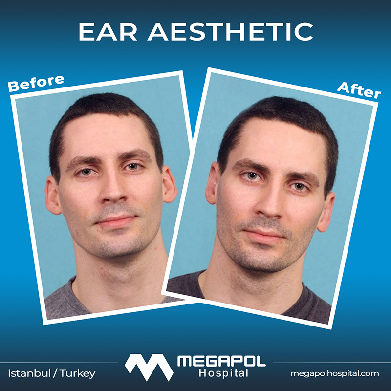 ear-3
