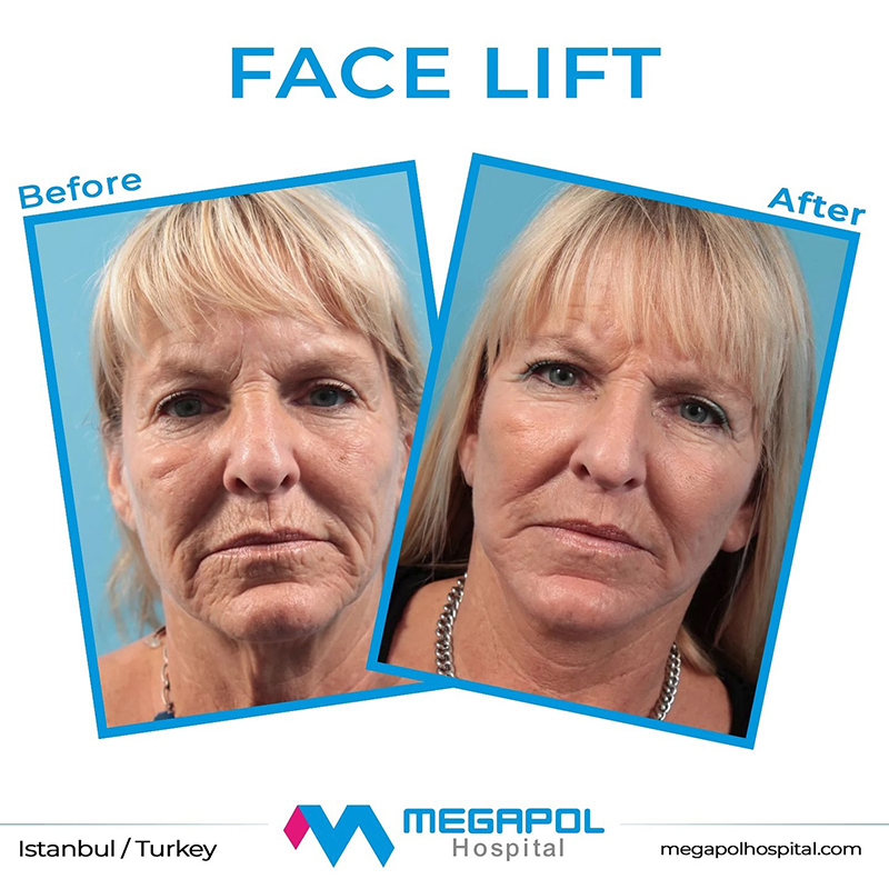 facelift-1