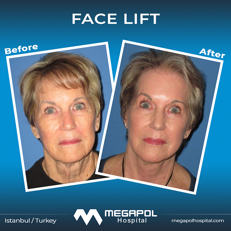 facelift-5