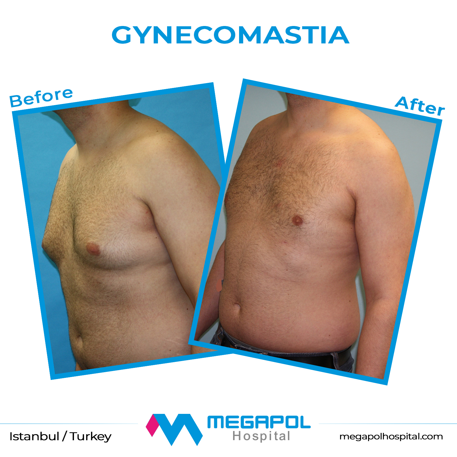 gynecomastia-1
