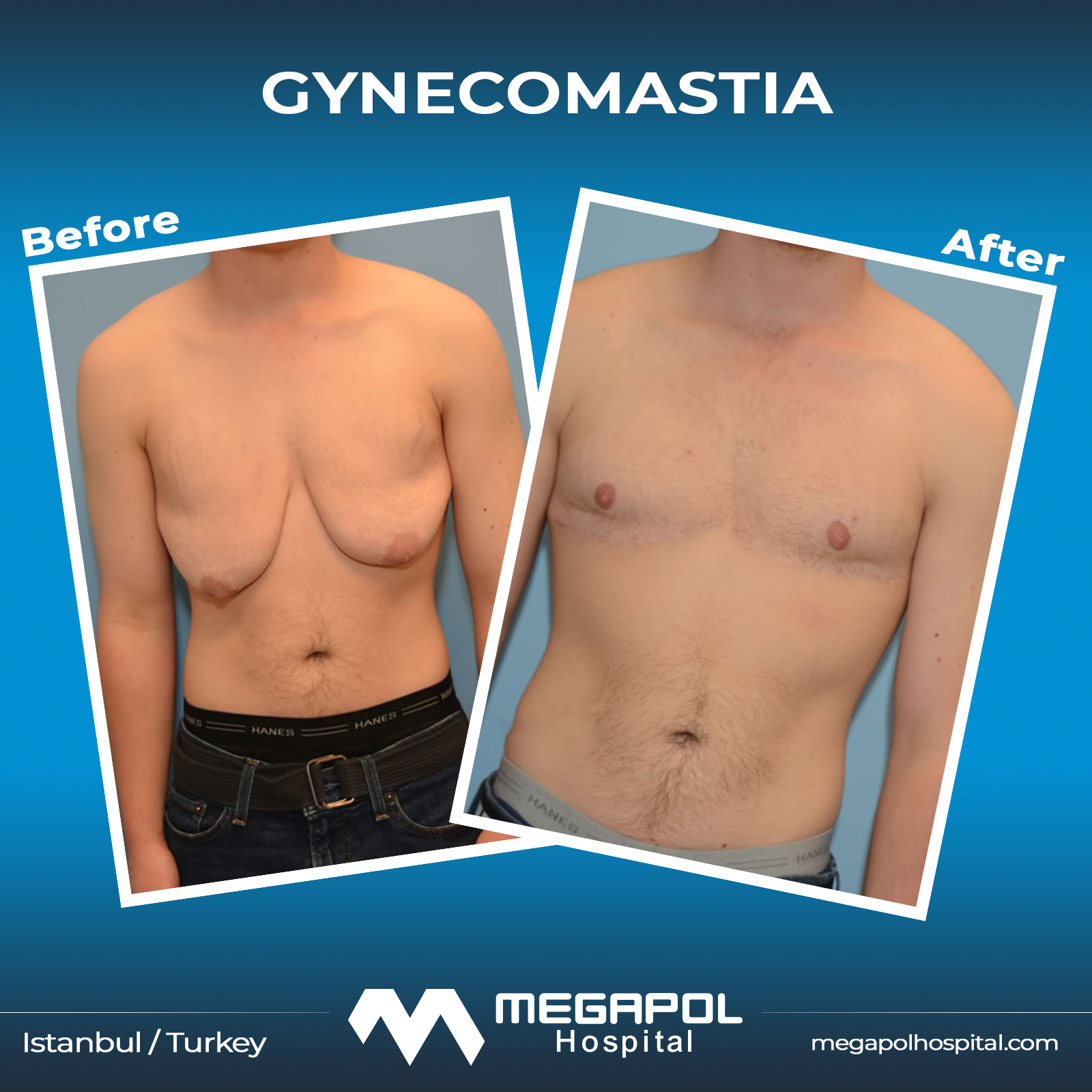 gynecomastia-2