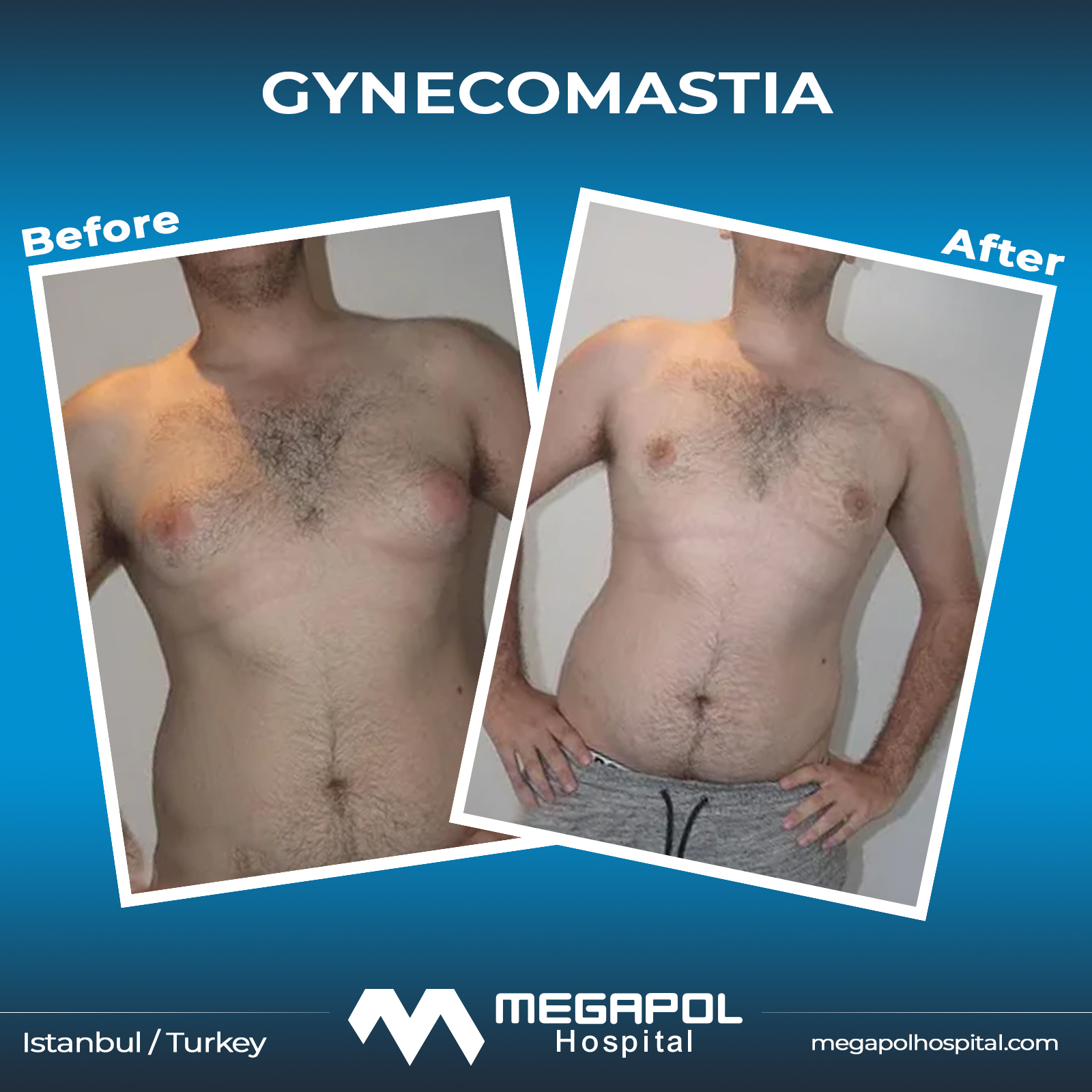 gynecomastia-3
