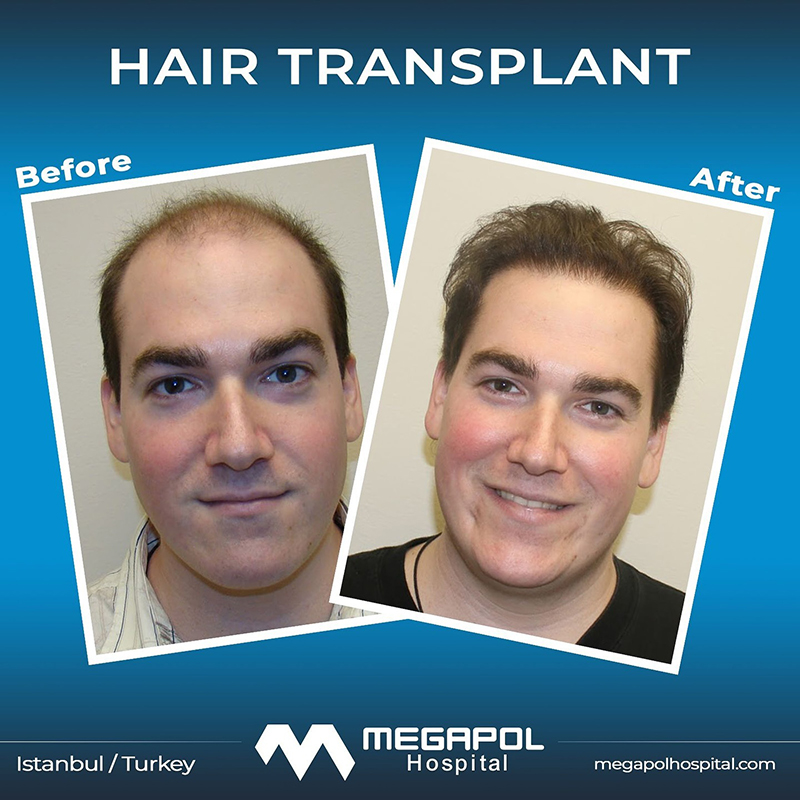 hair-transplant-1