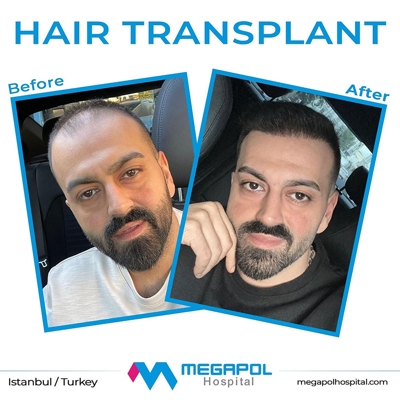 hair-transplant-2